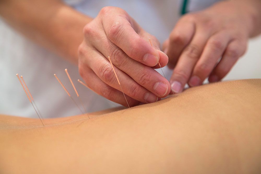 acupuntura