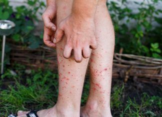 Urticaria aquagénica