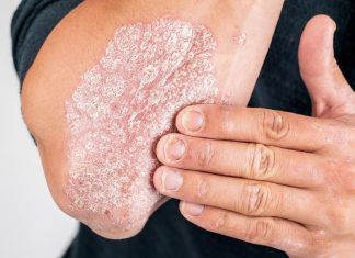 La Psoriasis La Psoriasis