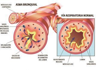 Diferencia entre Bronquitis y Asma