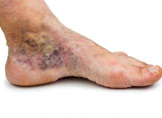 Cómo mejorar las varices con Homeopatía varices