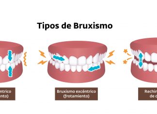 Cuando rechinar los dientes puede ser un problema: El bruxismo bruxismo
