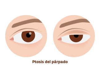 Inflamación de la córnea: queratitis queratitis