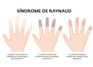 El Síndrome de Raynaud: dedos blancos, azules y rojos Síndrome de Raynaud