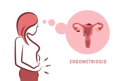endometriosis