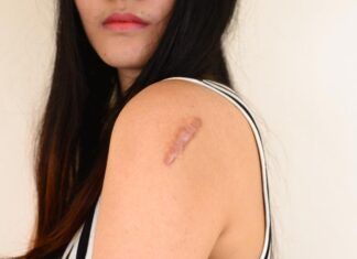 Recuperación de la piel post cicatrizada piel post cicatrizada