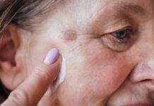 Manchas en la piel del rostro: causas, prevención y tratamientos