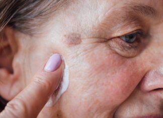 Manchas en la piel del rostro: causas, prevención y tratamientos