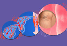 Consejos de salud para prevenir la aparición de varices Varicose veins on a female senior legs. The structure of normal and varicose veins. Concept of dry skin, old senior people, varicose veins and deep vein thrombosis or DVTc