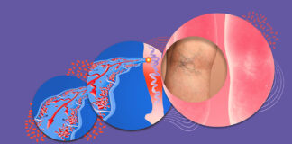 Consejos de salud para prevenir la aparición de varices Varicose veins on a female senior legs. The structure of normal and varicose veins. Concept of dry skin, old senior people, varicose veins and deep vein thrombosis or DVTc