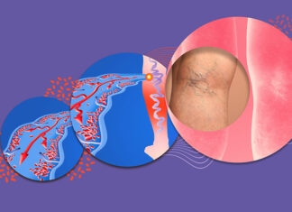 Consejos de salud para prevenir la aparición de varices Varicose veins on a female senior legs. The structure of normal and varicose veins. Concept of dry skin, old senior people, varicose veins and deep vein thrombosis or DVTc