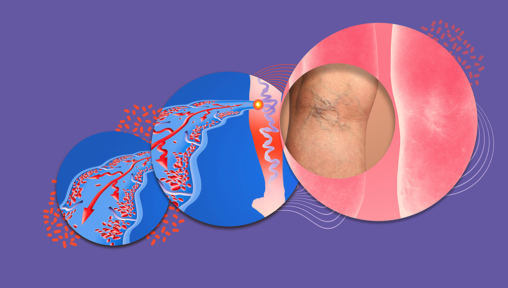 Varicose veins on a female senior legs. The structure of normal and varicose veins. Concept of dry skin, old senior people, varicose veins and deep vein thrombosis or DVTc