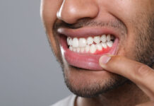 Cómo la fitoterapia ayuda a mejorar los resultados de los tratamientos odontológicos Man showing inflamed gum