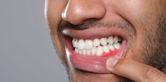 Cómo la fitoterapia ayuda a mejorar los resultados de los tratamientos odontológicos Man showing inflamed gum