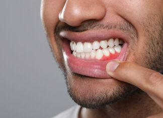 Cómo la fitoterapia ayuda a mejorar los resultados de los tratamientos odontológicos Man showing inflamed gum