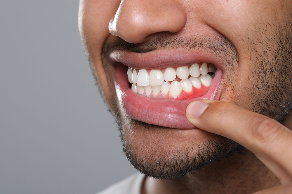 Man showing inflamed gum