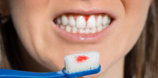 Omega-3 y periodontitis: la importancia de resolver la inflamación, ¿te sangran las encías al cepillarte los dientes? encías sangre